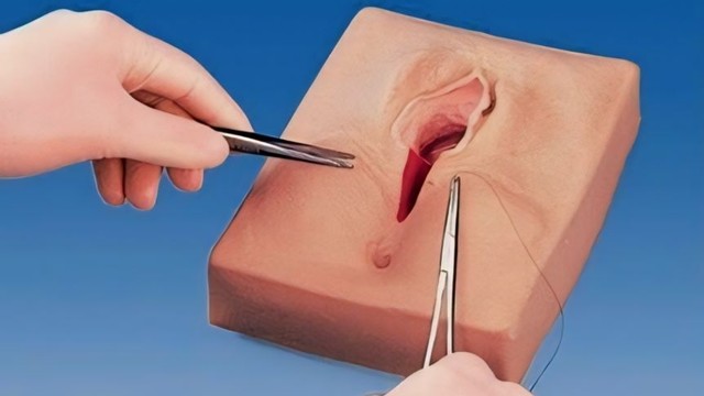 bai-viet/cat-moi-be-bao-lau-thi-lanh-nhung-dieu-can-luu-y-khi-thuc-hien-phau-thuat-cat-moi-be.html