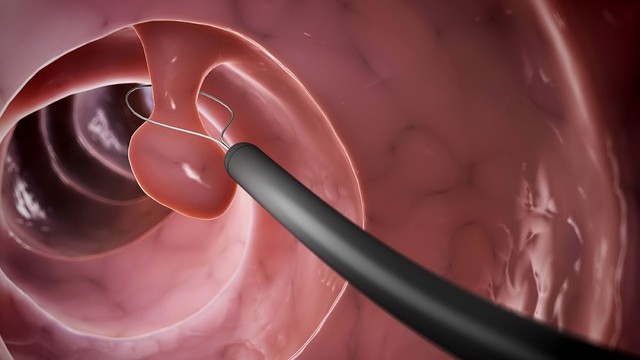 bai-viet/cat-polyp-da-day-va-nhung-dieu-ma-ban-can-biet.html