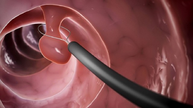 bai-viet/cat-polyp-truc-trang-co-nguy-hiem-khong.html