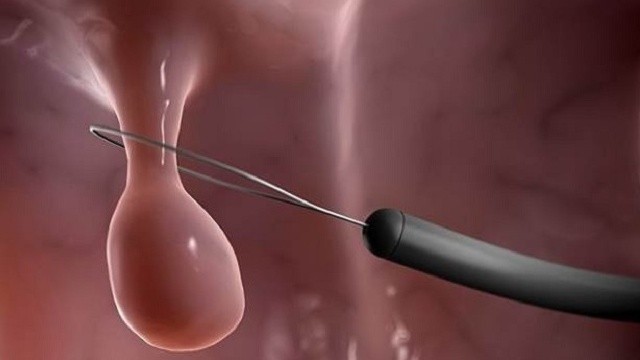 bai-viet/cat-polyp-tu-cung-bao-lau-thi-quan-he-lai-duoc-nhung-luu-y-khi-cat-cat-polyp-tu-cung.html