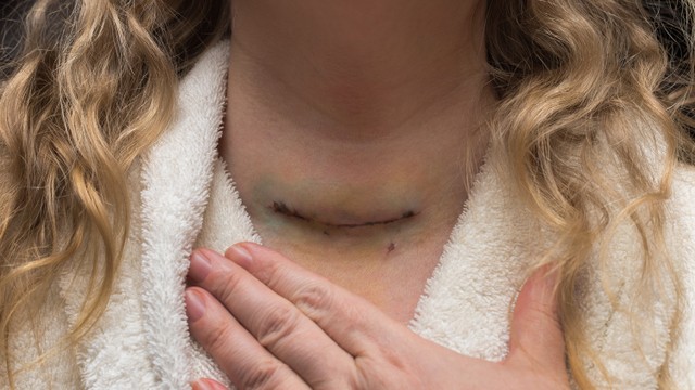 bai-viet/cat-tuyen-giap-co-anh-huong-den-sinh-ly-khong-bien-chung-sau-khi-cat-tuyen-giap.html