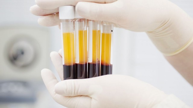 bai-viet/cay-prp-co-bong-da-khong-cach-cham-soc-da-sau-khi-cay-prp.html