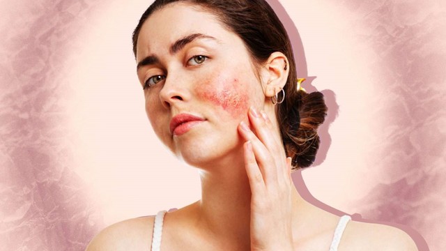 bai-viet/tim-hieu-ve-benh-cham-da-mat-nguyen-nhan-trieu-chung-va-cach-dieu-tri.html