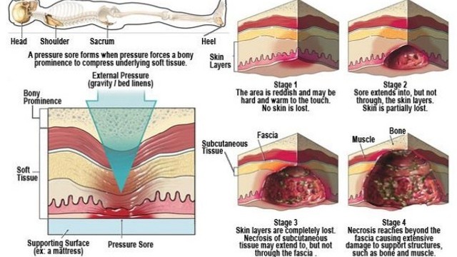 bai-viet/cham-soc-suc-khoe-thuoc-boi-loet-ty-de-59419.html