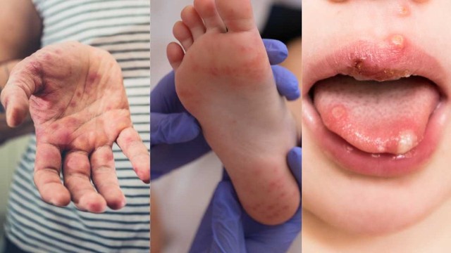 bai-viet/cham-soc-tre-bi-tay-chan-mieng-dung-cach-la-nhu-the-nao.html