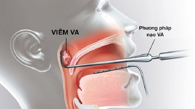 bai-viet/cham-soc-tre-sau-nao-va-nhu-the-nao-56031.html