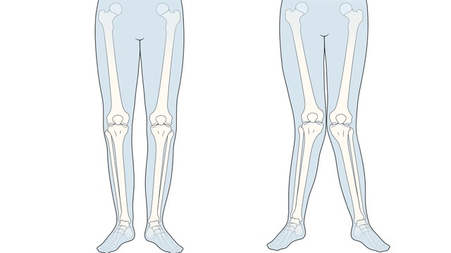 bai-viet/chan-chu-x-o-nguoi-lon-nguyen-nhan-trieu-chung-va-cach-dieu-tri.html