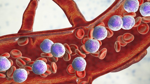 bai-viet/chan-doan-benh-bach-cau-cap-dong-lympho-o-tre-em-nhu-the-nao-61937.html