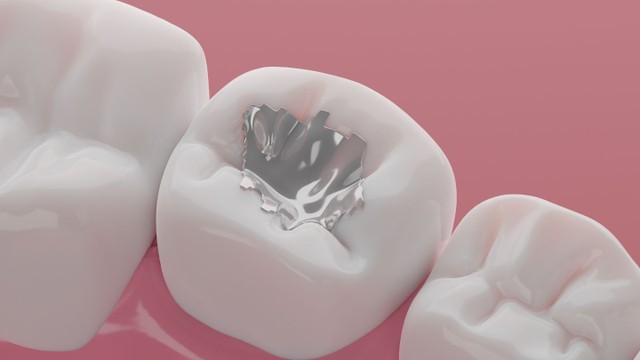 bai-viet/tim-hieu-chi-tiet-ve-cac-chat-han-rang-vinh-vien.html