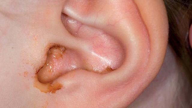 bai-viet/chay-mu-tai-o-tre-em-va-nhung-dieu-ba-me-can-biet-57202.html