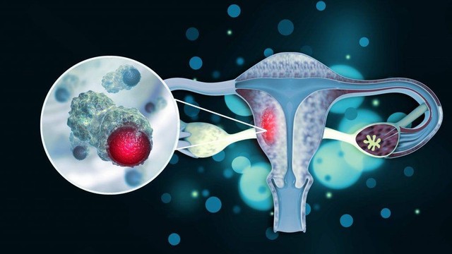 bai-viet/chi-em-can-biet-ung-thu-noi-mac-tu-cung-co-chua-khoi-khong.html