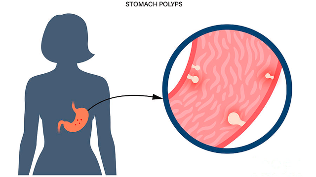 bai-viet/chi-phi-cat-polyp-da-day-bao-nhieu-khi-nao-can-cat-polyp-da-day.html