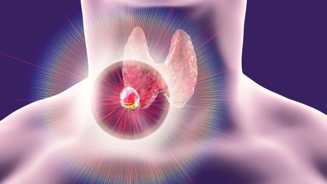 bai-viet/chi-phi-dieu-tri-ung-thu-tuyen-giap-gom-nhung-loai-gi-can-bao-nhieu-tien.html