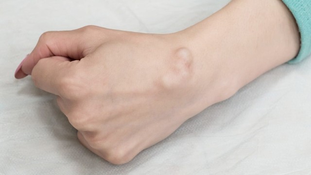 bai-viet/tham-khao-chi-phi-mo-u-nang-bao-hoat-dich-va-nhung-luu-y-quan-trong-sau-khi-mo.html