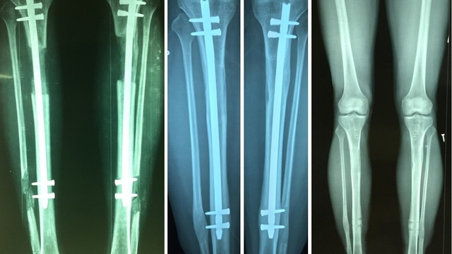 bai-viet/chi-phi-phau-thuat-keo-dai-chan-la-bao-nhieu-61041.html