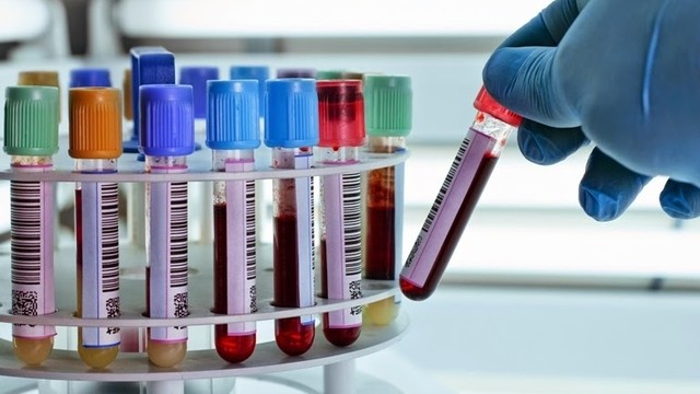 bai-viet/chi-so-amh-binh-thuong-la-bao-nhieu-ai-nen-xet-nghiem-chi-so-amh.html