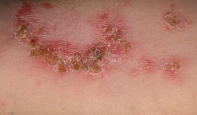 bai-viet/choc-lo-o-mong-phai-lam-sao-de-nhanh-khoi-57052.html