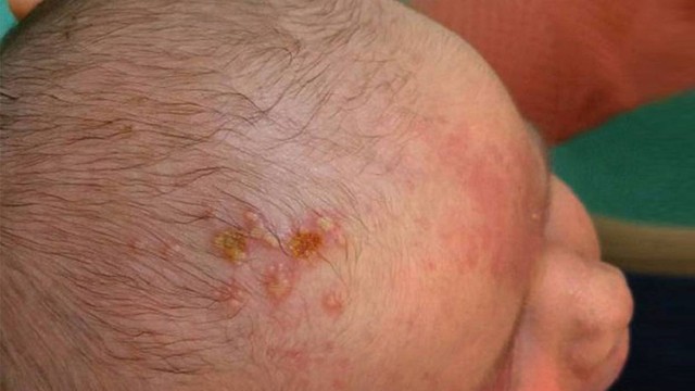 bai-viet/choc-lo-tren-dau-co-nguy-hiem-khong-nguyen-nhan-va-cach-chua-tri-59590.html