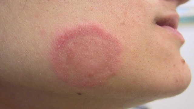 bai-viet/chua-hac-lao-bang-du-du-co-hieu-qua-khong.html