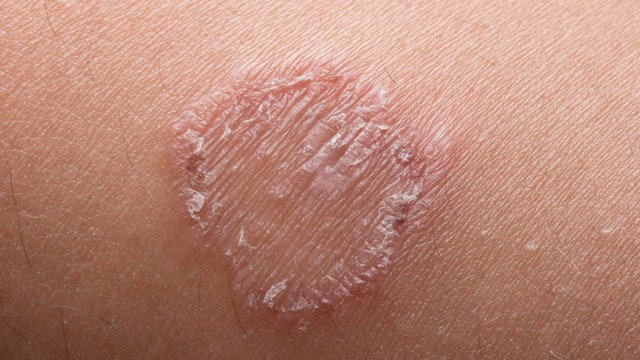 bai-viet/meo-chua-hac-lao-bang-gung-co-hieu-qua-khong.html