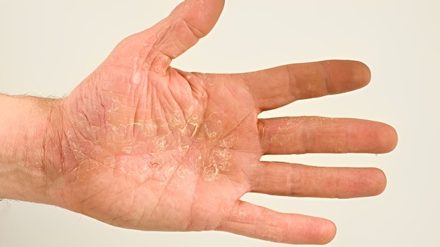 bai-viet/chua-to-dia-bang-cu-ray-co-hieu-qua-khong-ap-dung-the-nao.html