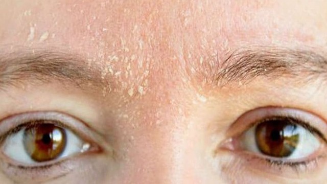 bai-viet/chua-viem-da-tiet-ba-bang-dan-gian-66545.html