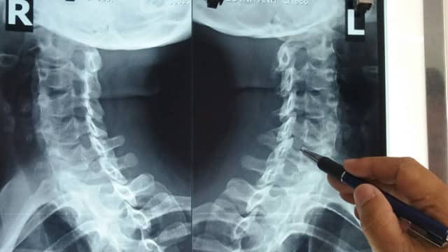 bai-viet/chup-x-quang-cot-song-co-chech-3-4-quy-trinh-nhu-the-nao.html