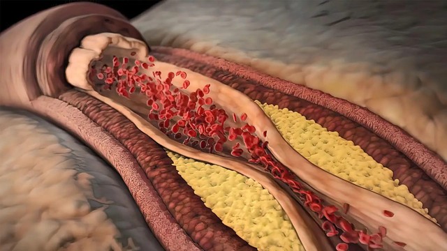 bai-viet/co-che-hinh-thanh-mang-xo-vua-va-cach-ngan-ngua-xo-vua-dong-mach.html