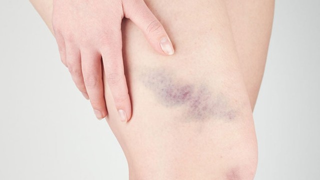 bai-viet/co-nen-chuom-nong-de-tan-mau-bam-hay-khong-68840.html