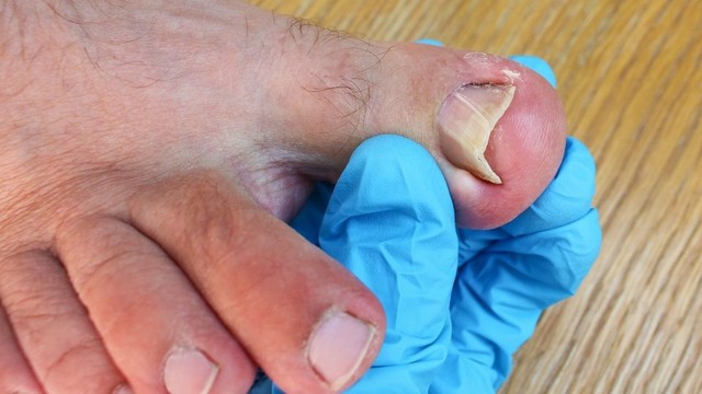 bai-viet/co-nen-lay-khoe-mong-chan-khong-cach-lay-khoe-mong-chan-an-toan-59839.html