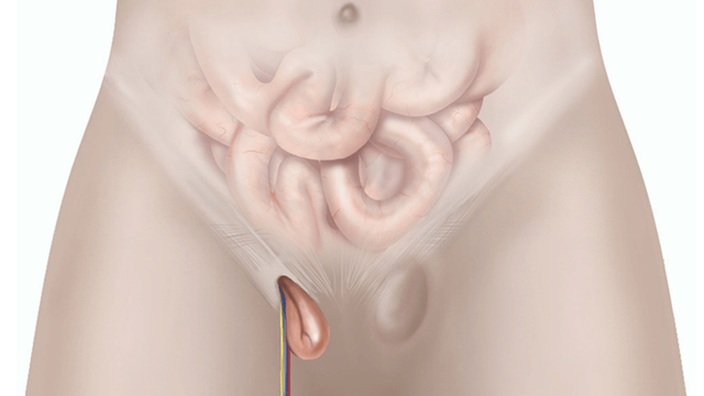 bai-viet/co-the-chua-thoat-vi-ben-bang-thuoc-khong.html