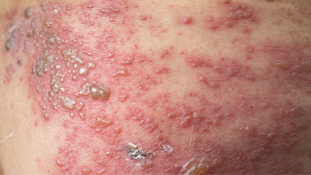 bai-viet/con-gioi-leo-la-gi-mot-so-the-benh-gioi-leo-pho-bien.html