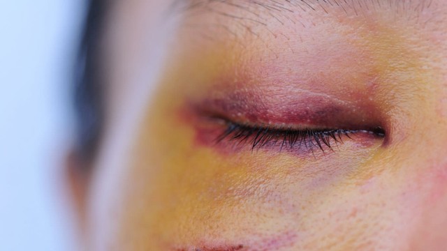 bai-viet/tu-nhien-bi-bam-tim-o-mat-la-do-dau-va-cach-khac-phuc.html