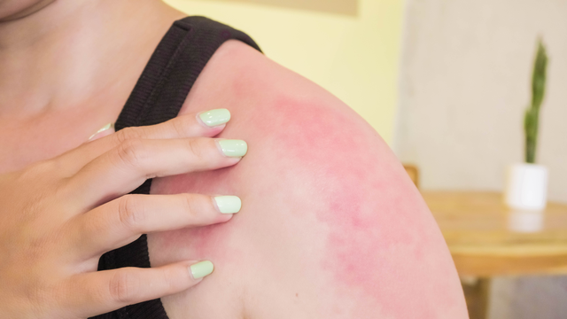 bai-viet/cryptococcus-neoformans-la-gi-nhung-benh-ly-thuong-gap-va-cach-phong-ngua.html