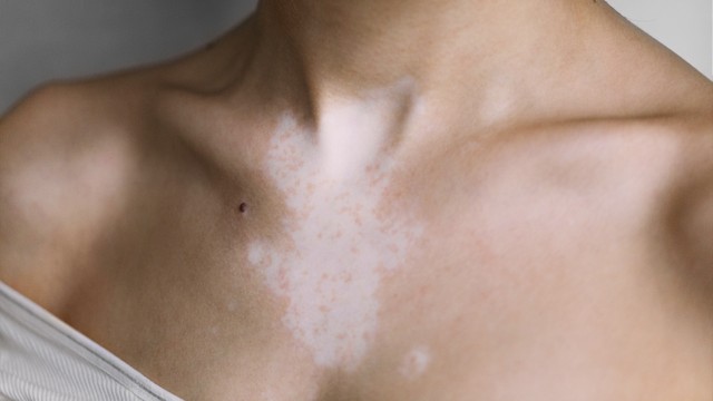 bai-viet/da-bi-mat-sac-to-phai-lam-sao.html