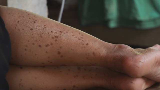 bai-viet/da-chan-bi-dom-nau-nguyen-nhan-cach-can-thiep-va-phong-ngua.html