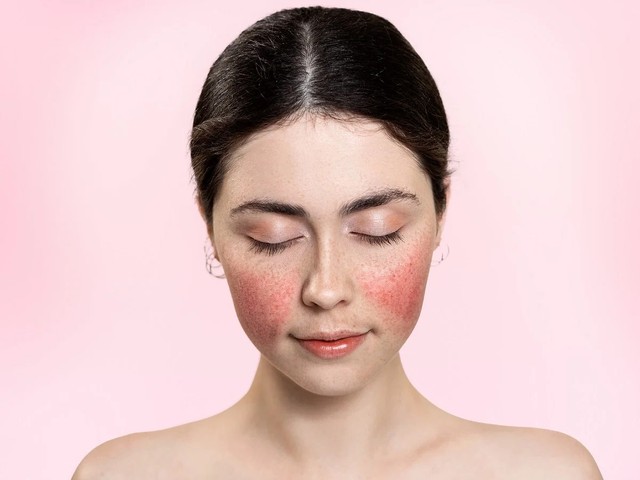 bai-viet/da-mat-bi-do-dau-hieu-cua-hoi-chung-rosacea.html