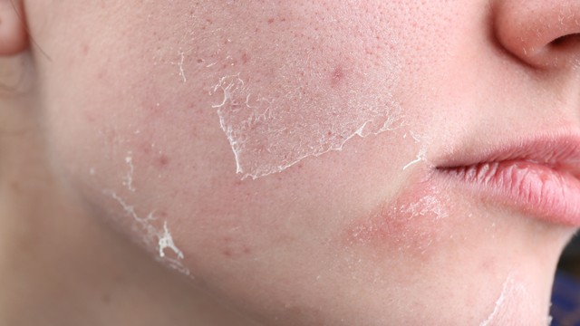 bai-viet/da-mat-kho-nguyen-nhan-va-cach-khac-phuc-hieu-qua-ngay-tai-nha.html