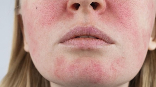 bai-viet/da-mat-nong-bung-va-hong-do-canh-bao-benh-ly-gi.html