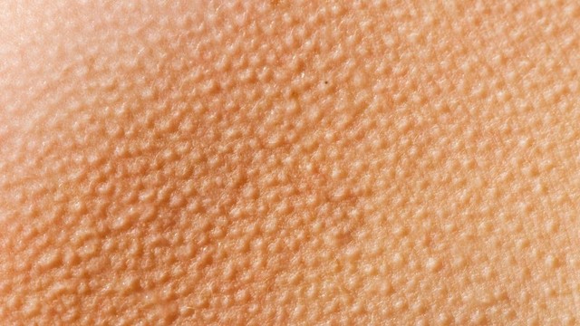 bai-viet/da-mong-san-sui-nhu-da-ga-chua-bang-cach-nao-63461.html