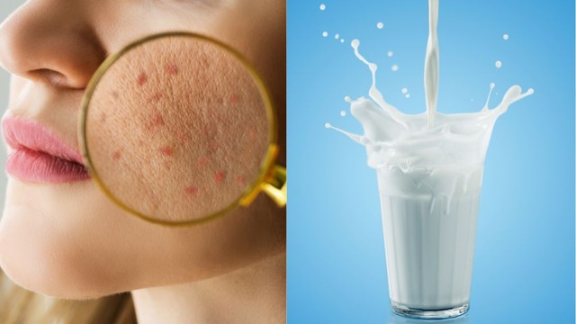 bai-viet/da-mun-co-nen-dung-sua-tuoi-rua-mat-khong.html