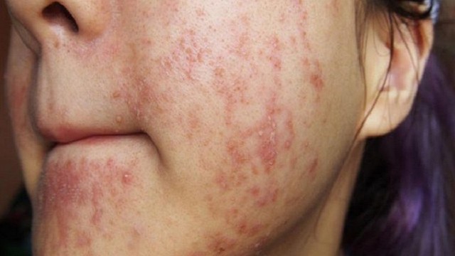 bai-viet/da-nhiem-corticoid-nen-an-gi-va-kieng-an-gi-de-nhanh-phuc-hoi.html