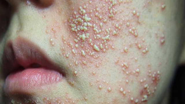 bai-viet/da-nhiem-corticoid-nhe-nen-lam-gi.html