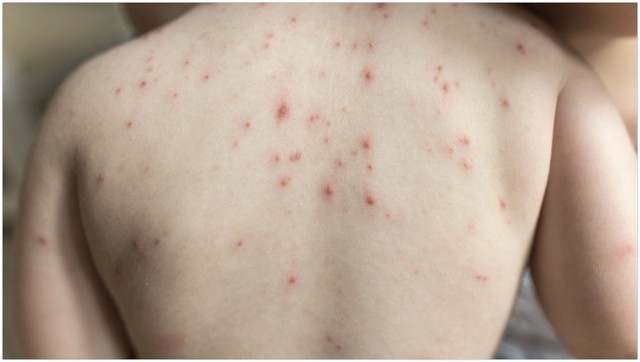 bai-viet/da-noi-nhung-hat-nho-khong-ngua-la-tinh-trang-gi.html