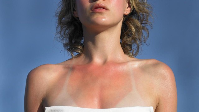 bai-viet/da-ram-nang-la-gi-cach-phuc-hoi-lan-da-ram-nang.html