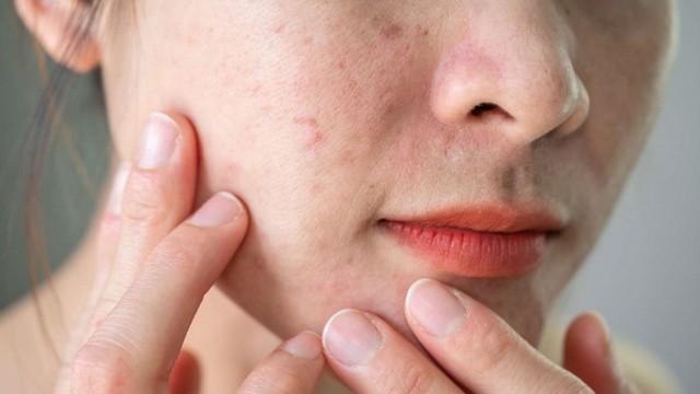 bai-viet/da-san-sui-mun-an-nguyen-nhan-va-cach-dieu-tri.html