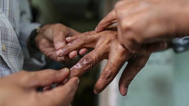 bai-viet/dac-diem-cua-benh-phong-cui-la-gi-benh-co-lay-truyen-khong-68807.html