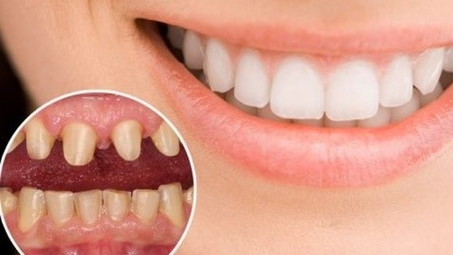 bai-viet/giai-dap-thac-mac-dan-su-veneer-co-anh-huong-gi-khong-63766.html