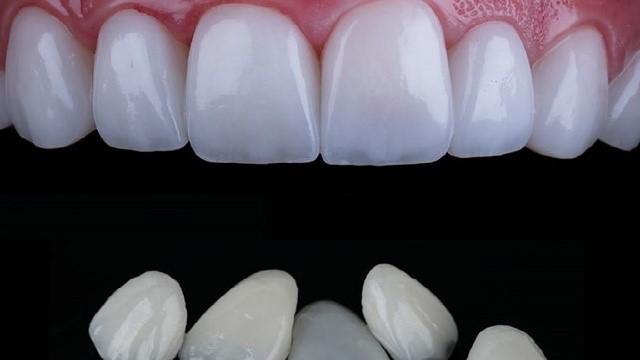 bai-viet/dan-su-veneer-diamond-co-tot-khong-chi-phi-the-nao-63750.html