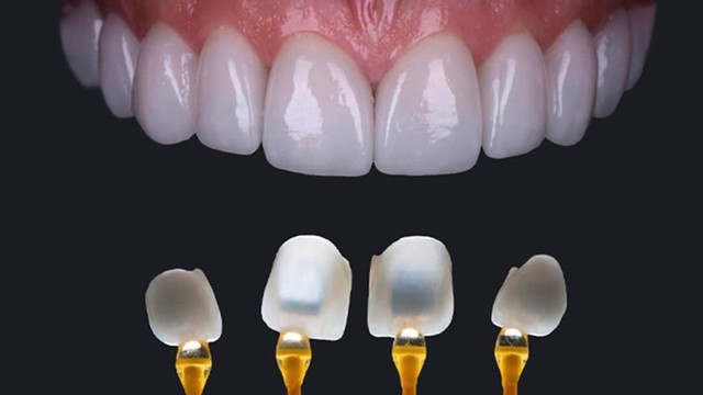 bai-viet/dan-su-veneer-la-gi-dan-su-veneer-co-ben-khong-64514.html